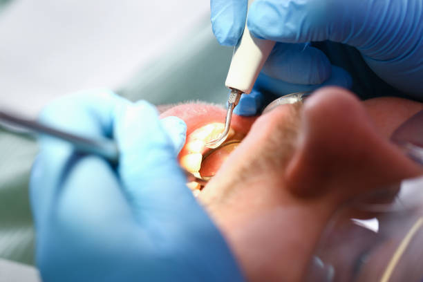 Best Emergency Wisdom Teeth Removal in Reynolds Heights, PA